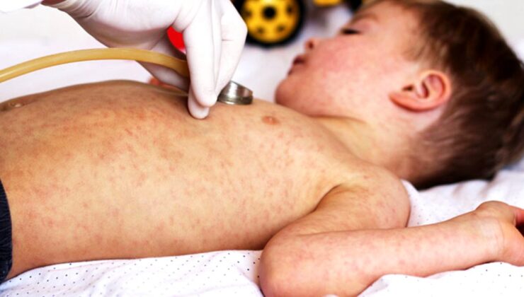 Dünyadaki aşı karşıtlığı kızamık vakalarını patlattı! Profesör, ‘Koronavirüsten daha tehlikeli’ diyerek uyardı