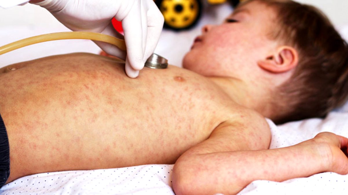 Dünyadaki aşı karşıtlığı kızamık vakalarını patlattı! Profesör, ‘Koronavirüsten daha tehlikeli’ diyerek uyardı