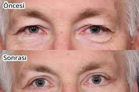 Göz Kapağı Ameliyatı İçin Kullanılan Teknikler Nelerdir?