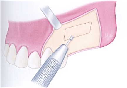 Seramik İmplant mı Titanyum İmplant mı? Hangisi Sizin İçin Doğru?